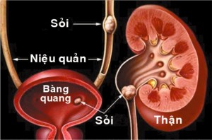 cách trị bệnh sỏi thận