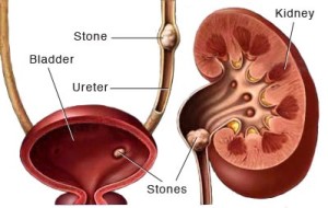 cách chữa sỏi thận hiệu quả