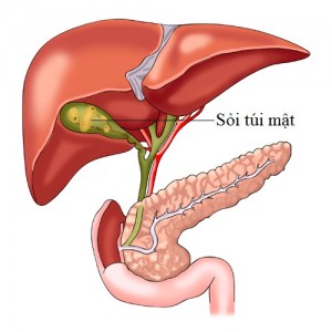 Bệnh sỏi túi mật và cách điều trị