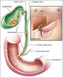 Triệu chứng bệnh sỏi mật