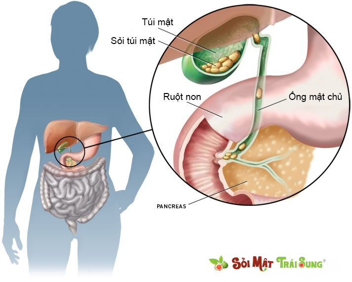 Sỏi Mật Trái Sung