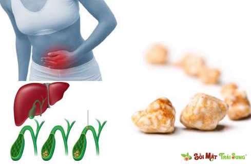 Sỏi Mật Trái Sung