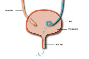 sỏi tiết niệu