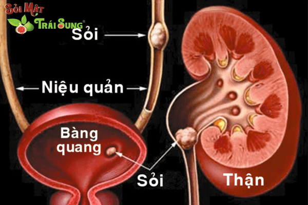 Sỏi Mật Trái Sung