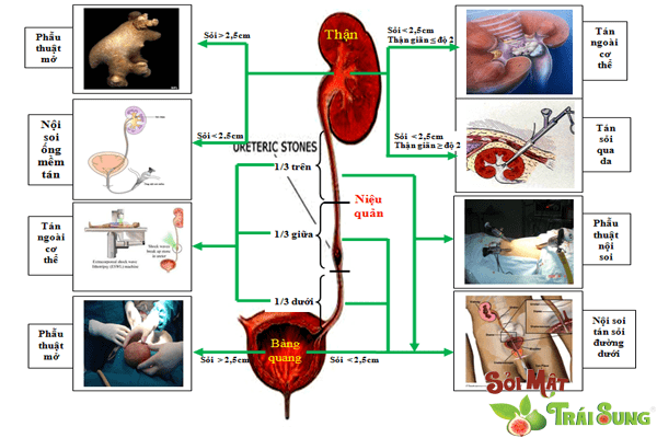 Sỏi Mật Trái Sung
