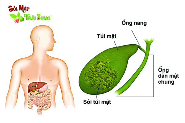 Sỏi Mật Trái Sung