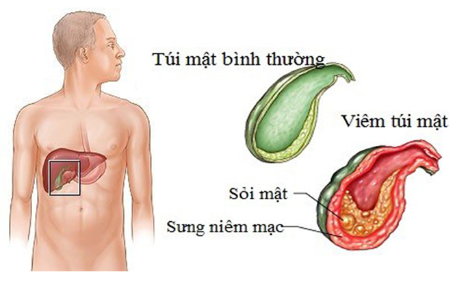 Sỏi Mật Trái Sung