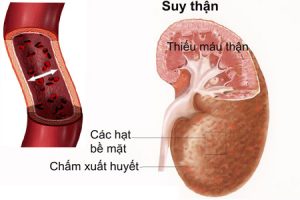 suy thận, sỏi thận, người suy thận