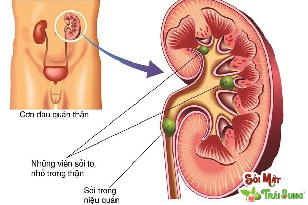 Sỏi Mật Trái Sung