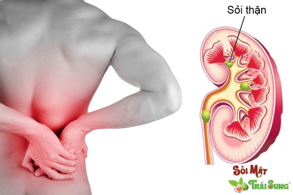 Sỏi Mật Trái Sung