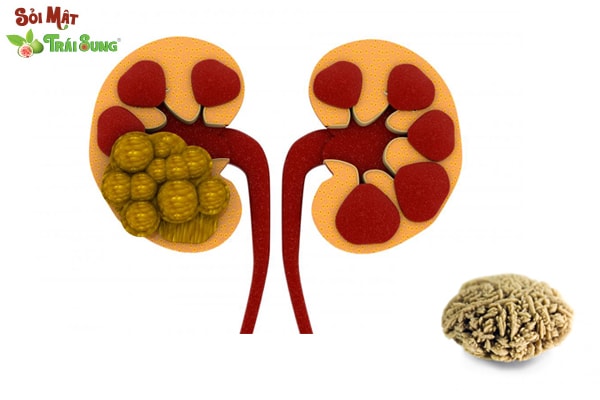 Sỏi Mật Trái Sung