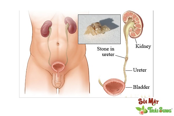 Sỏi Mật Trái Sung