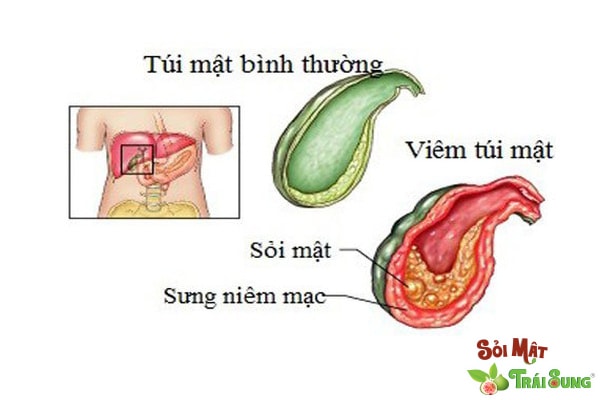 Sỏi Mật Trái Sung