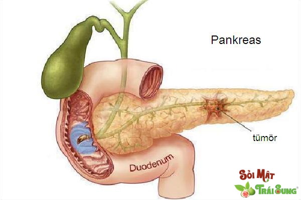 Sỏi Mật Trái Sung