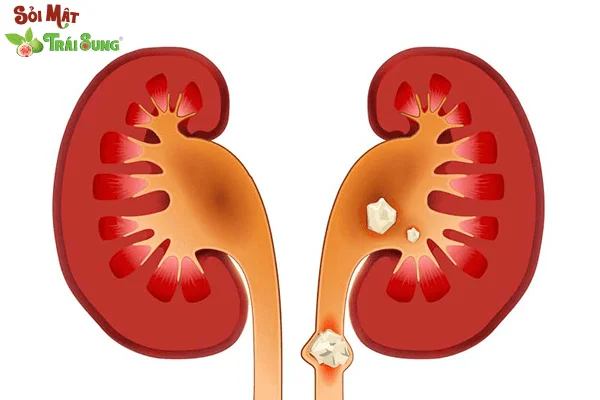 Sỏi Mật Trái Sung