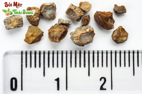 Sỏi Mật Trái Sung