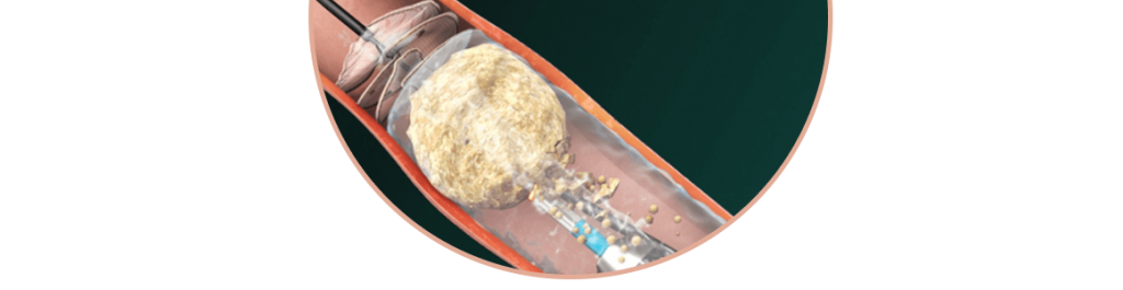 Sỏi Mật Trái Sung