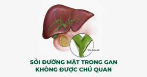 SỎI ĐƯỜNG MẬT TRONG GAN – KHÔNG ĐƯỢC CHỦ QUAN