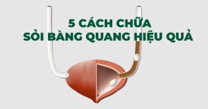 5 CÁCH CHỮA SỎI BÀNG QUANG HIỆU QUẢ