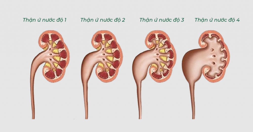Sỏi Mật Trái Sung