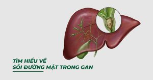 TÌM HIỂU VỀ SỎI ĐƯỜNG MẬT TRONG GAN