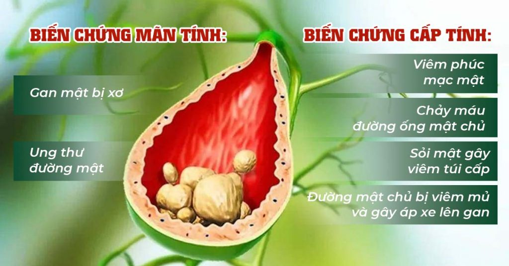 Sỏi Mật Trái Sung