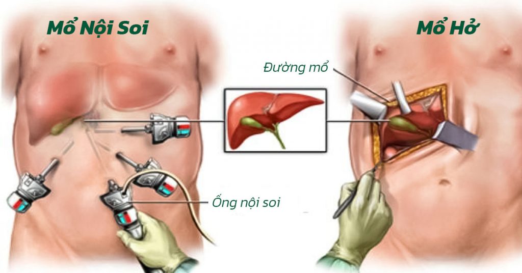 Sỏi Mật Trái Sung