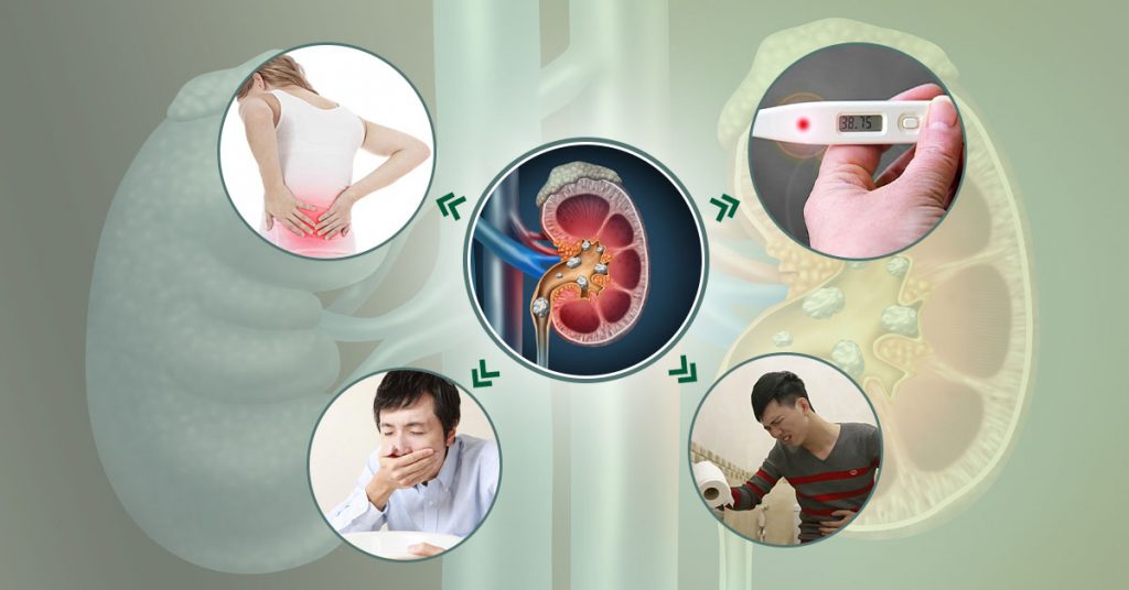 Sỏi Mật Trái Sung