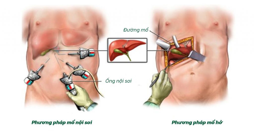 Sỏi Mật Trái Sung