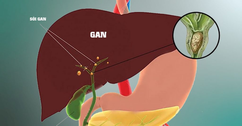 Sỏi Mật Trái Sung
