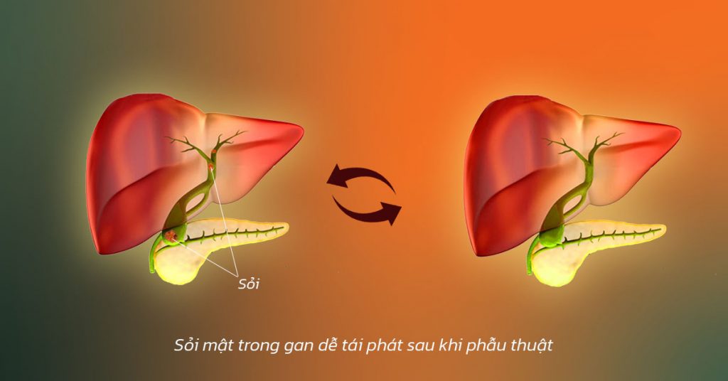 Sỏi Mật Trái Sung