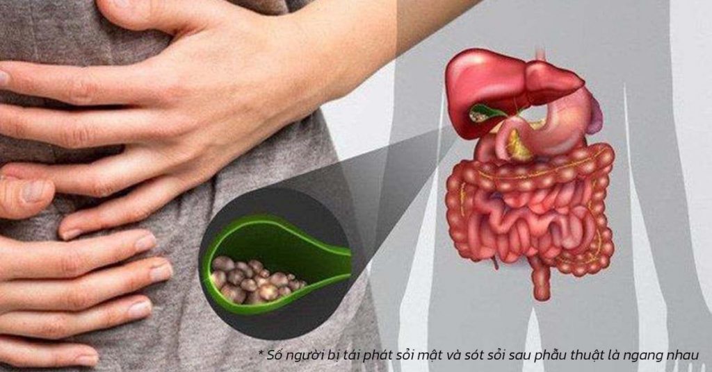 Sỏi Mật Trái Sung