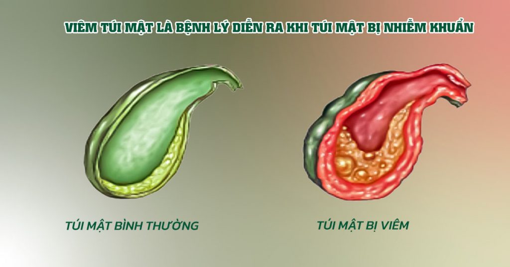 Sỏi Mật Trái Sung
