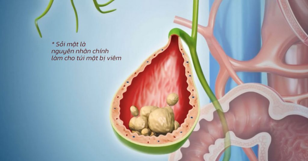 Sỏi Mật Trái Sung