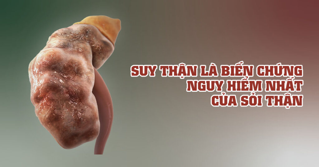Sỏi Mật Trái Sung
