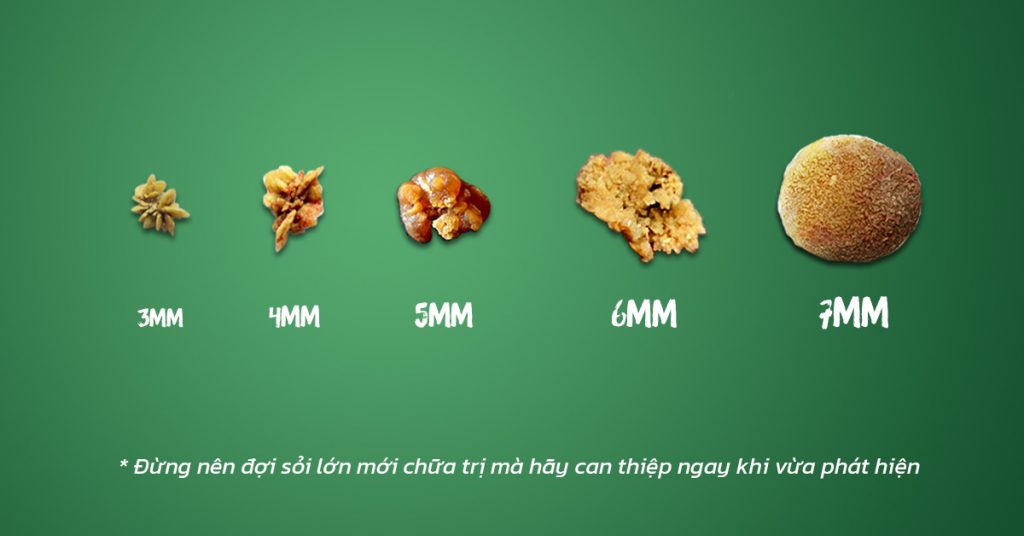 Sỏi Mật Trái Sung