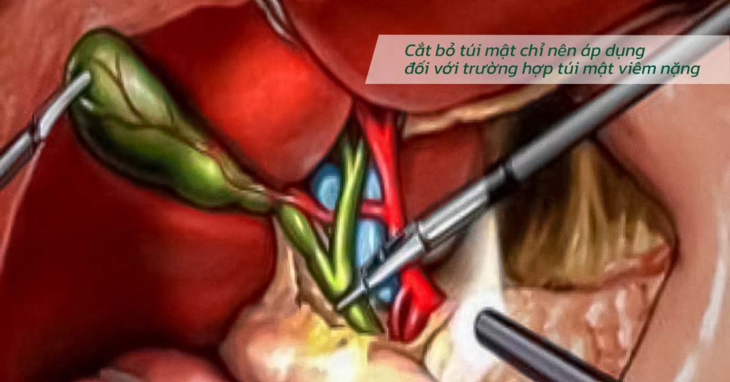 Sỏi Mật Trái Sung
