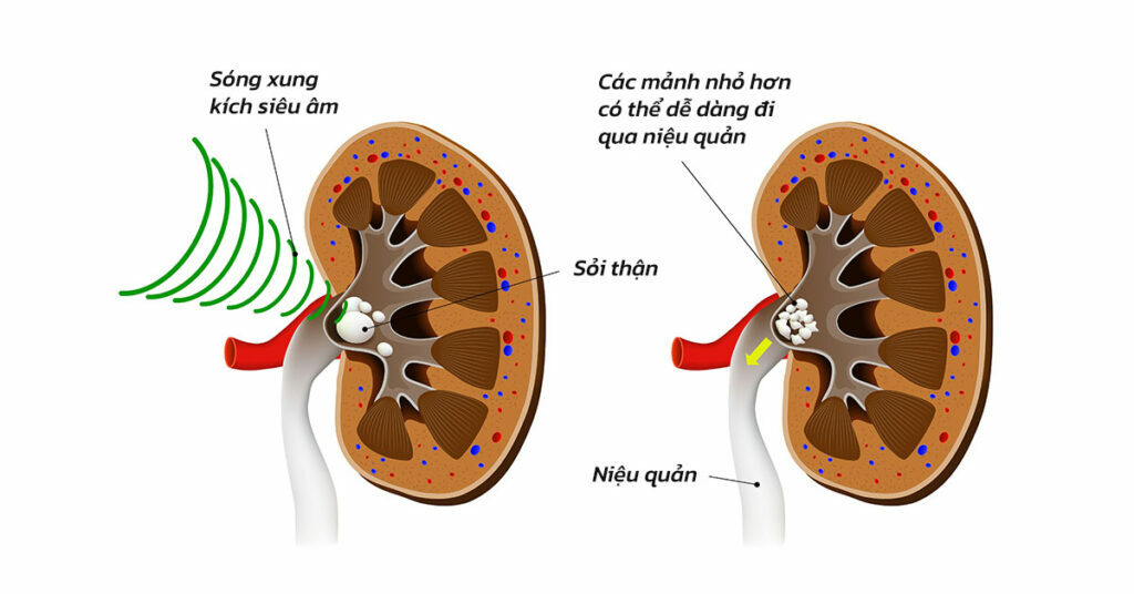 Sỏi Mật Trái Sung