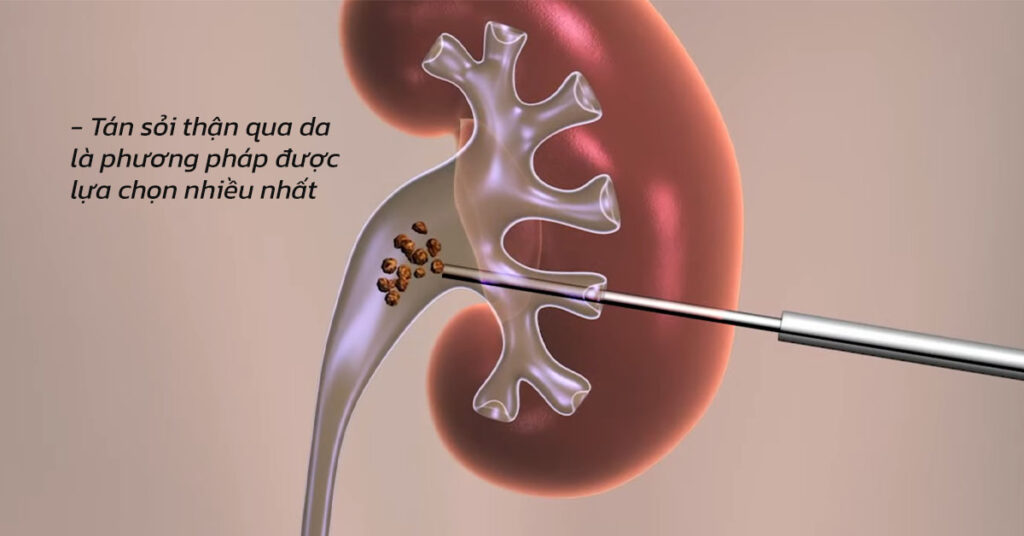Sỏi Mật Trái Sung