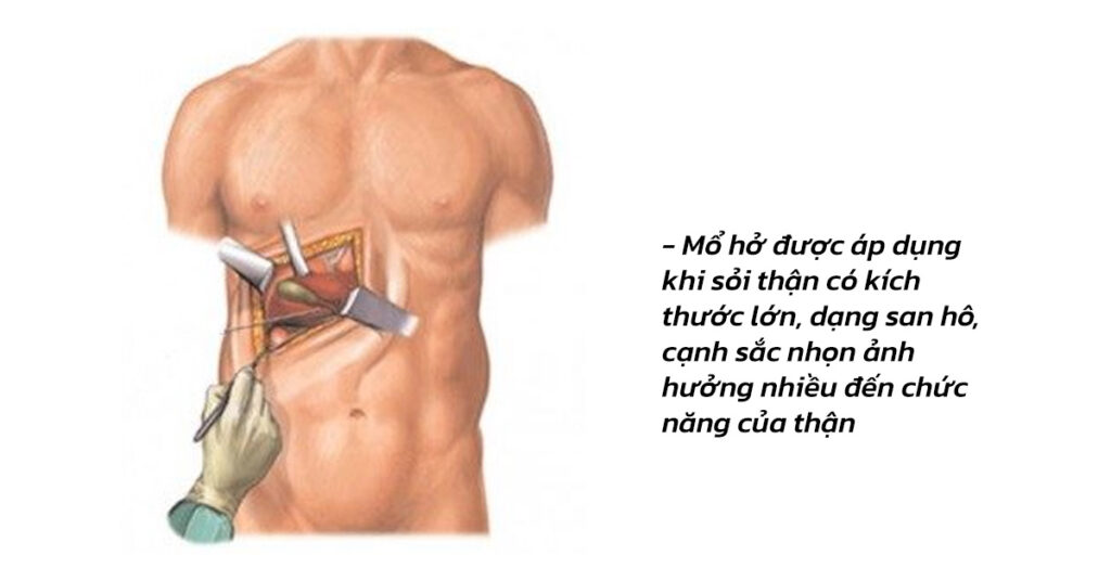 Sỏi Mật Trái Sung