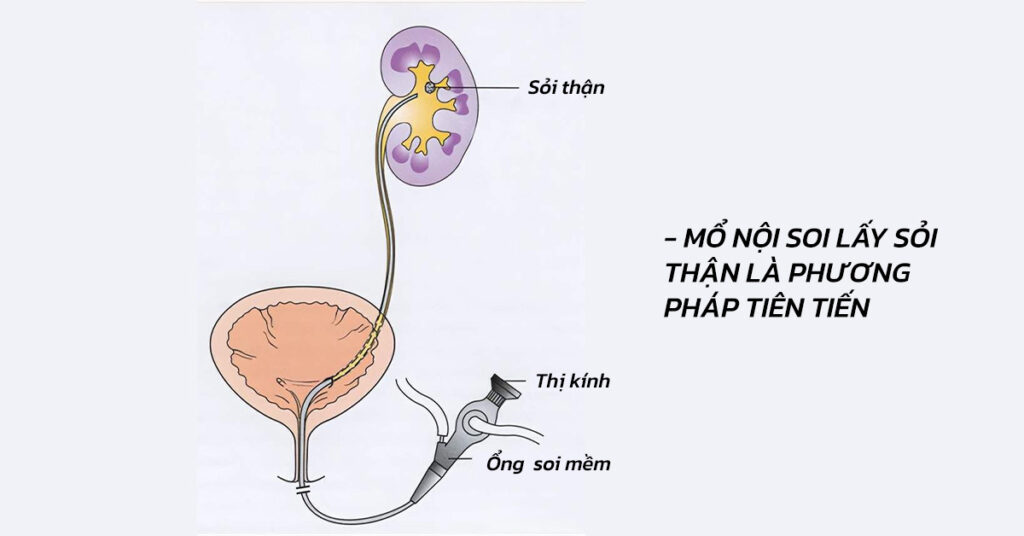Sỏi Mật Trái Sung
