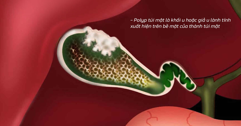 Sỏi Mật Trái Sung