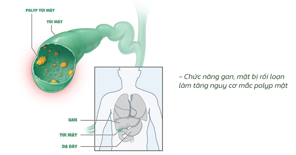 Sỏi Mật Trái Sung