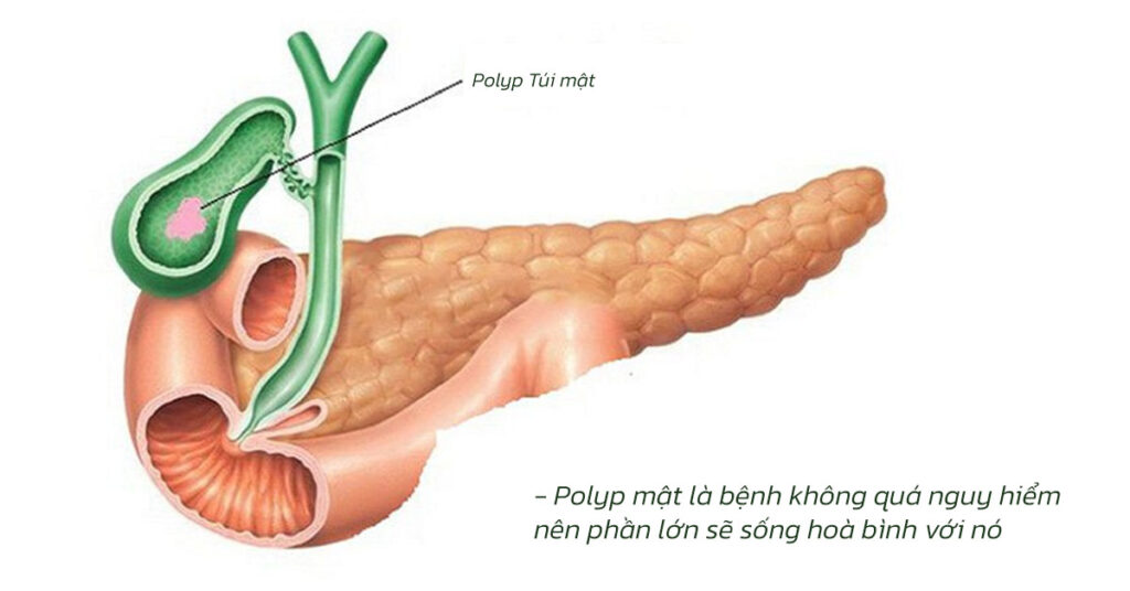 Sỏi Mật Trái Sung