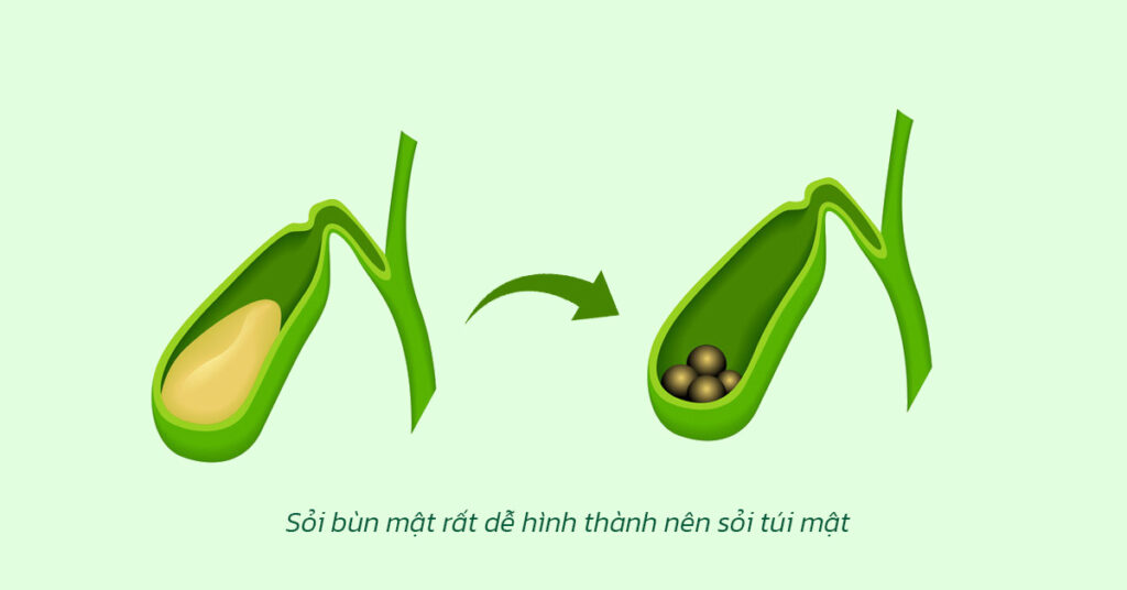 Sỏi Mật Trái Sung