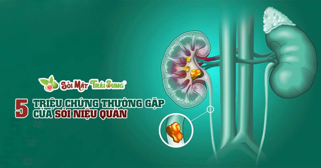 Sỏi Mật Trái Sung