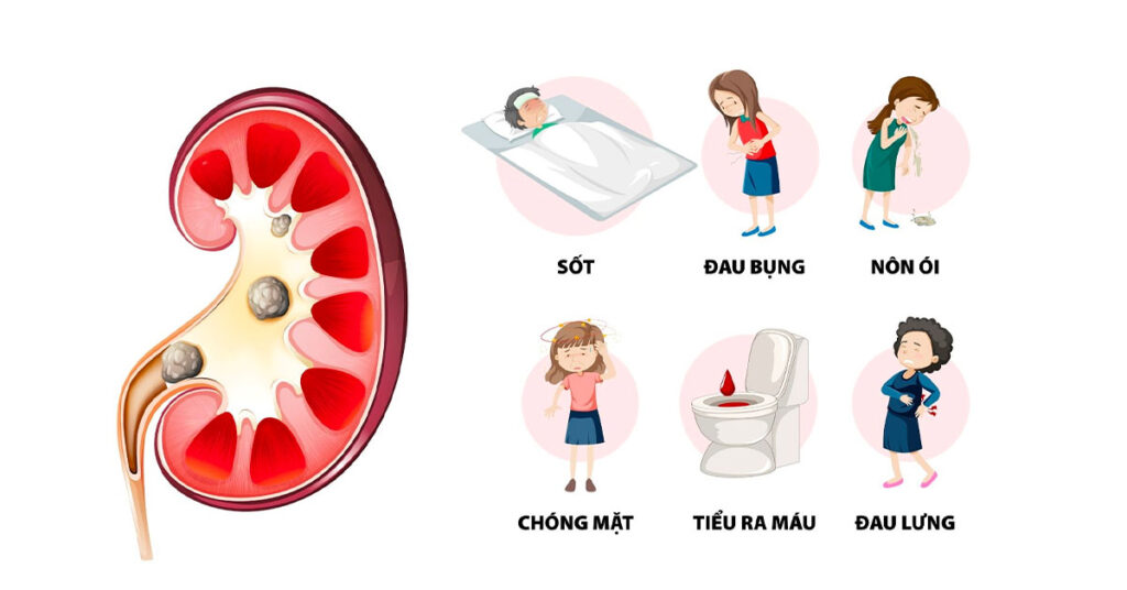 Sỏi Mật Trái Sung