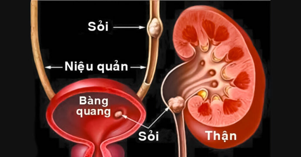 Sỏi Mật Trái Sung