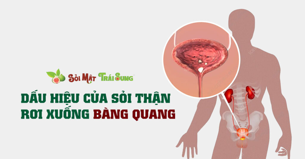 Sỏi Mật Trái Sung