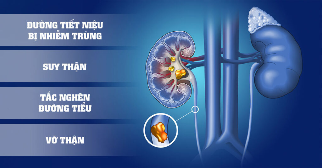 Sỏi Mật Trái Sung